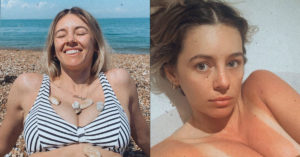 keeley hazell bikini sunburn